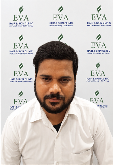 After hair transplant result 8
